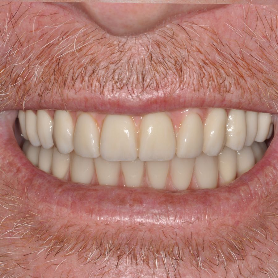 smile in a day after smile 13 - 3Dental